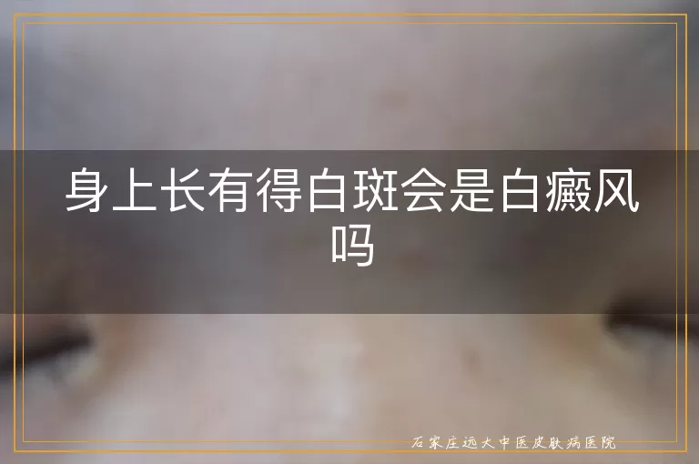 身上长有得白斑会是白癜风吗