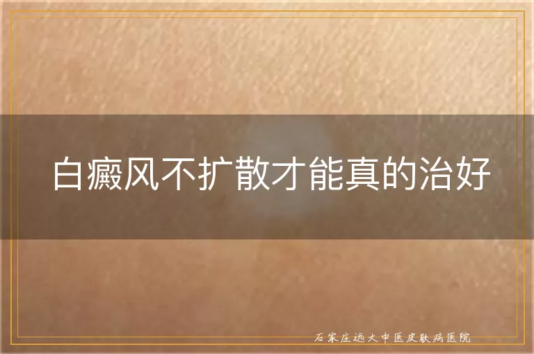 白癜风不扩散才能真的治好
