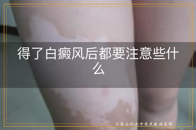 得了白癜风后都要注意些什么