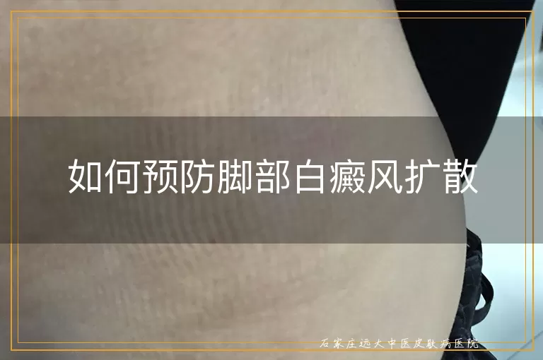 如何预防脚部白癜风扩散