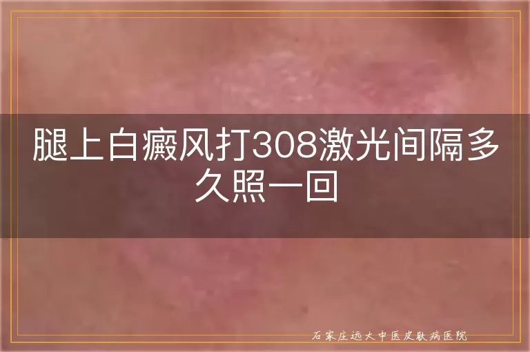 腿上白癜风打308激光间隔多久照一回