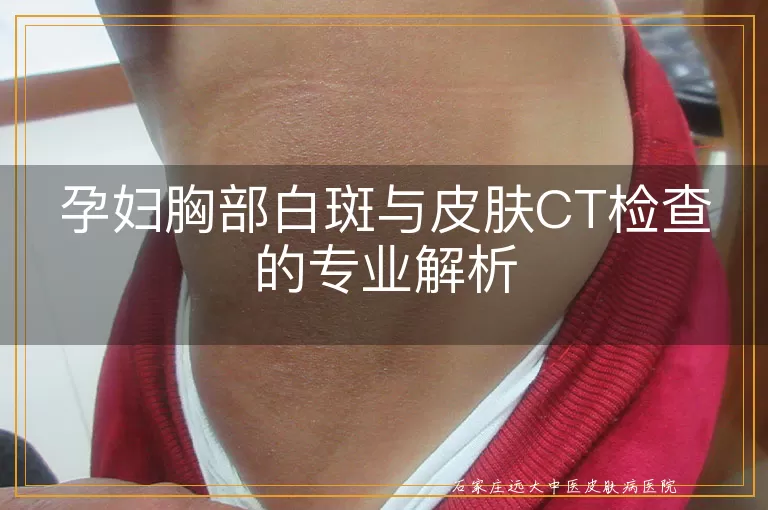 孕妇胸部白斑与皮肤CT检查的专业解析