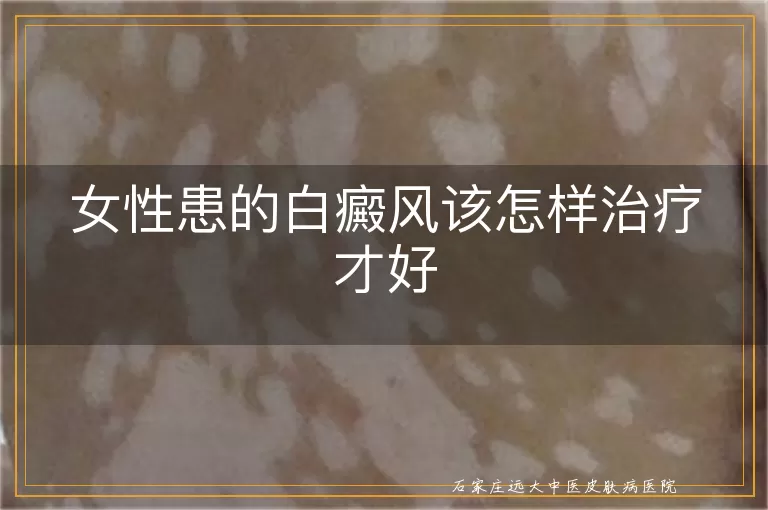 女性患的白癜风该怎样治疗才好