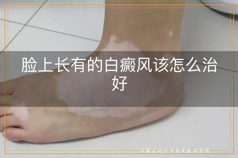 脸上长有的白癜风该怎么治好
