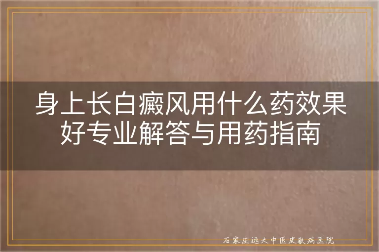 身上长白癜风用什么药效果好专业解答与用药指南