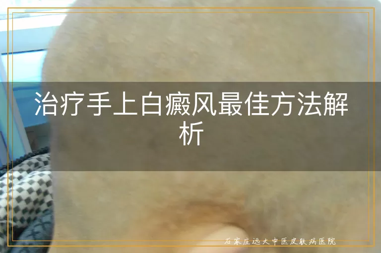 治疗手上白癜风最佳方法解析