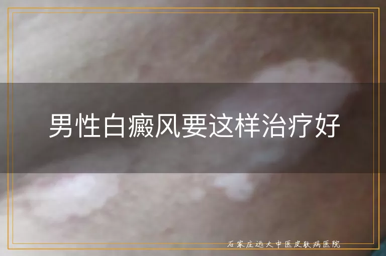男性白癜风要这样治疗好