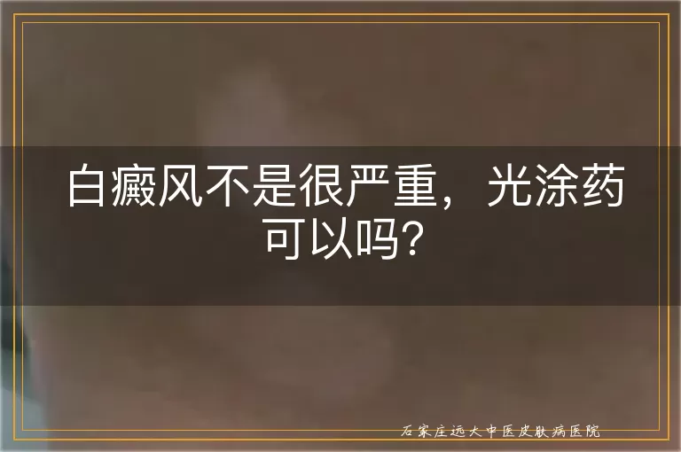 白癜风不是很严重，光涂药可以吗？