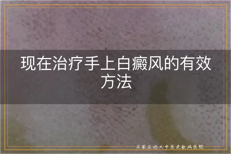 现在治疗手上白癜风的有效方法