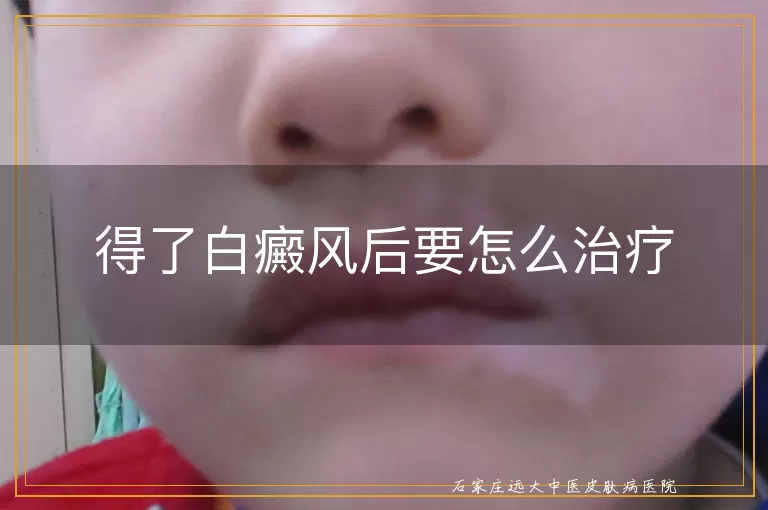 得了白癜风后要怎么治疗