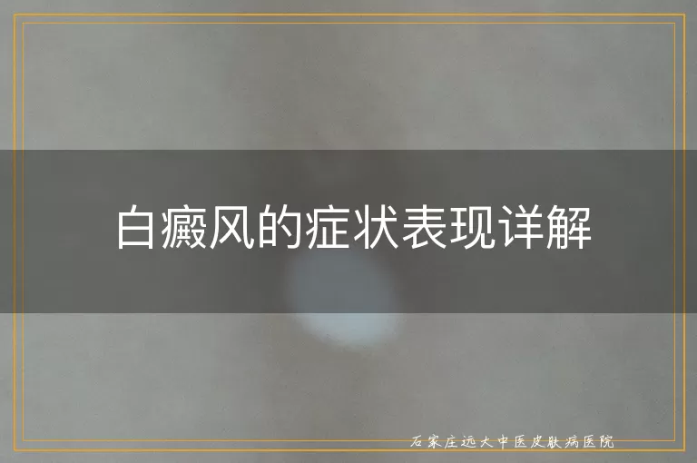 白癜风的症状表现详解