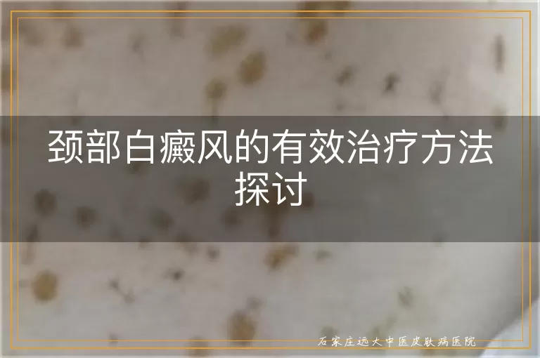 颈部白癜风的有效治疗方法探讨