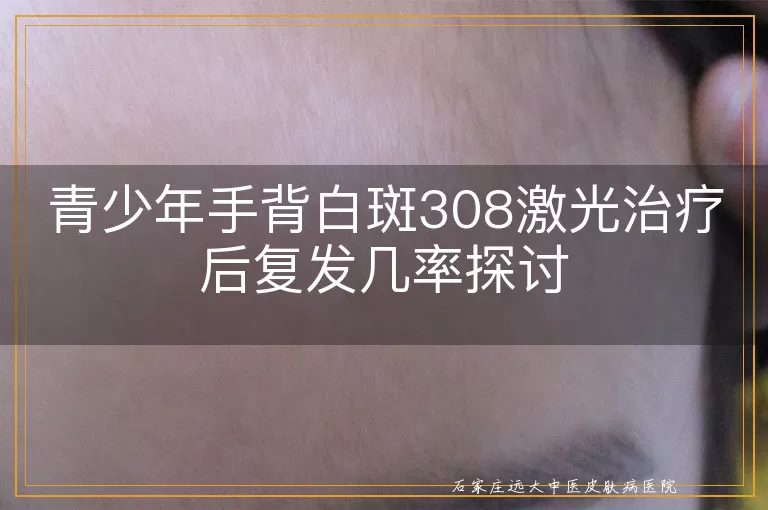 青少年手背白斑308激光治疗后复发几率探讨