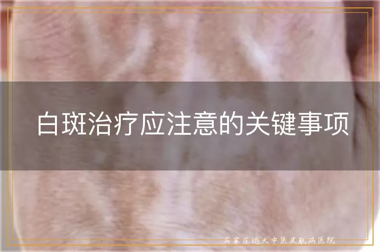 白斑治疗应注意的关键事项