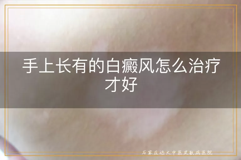 手上长有的白癜风怎么治疗才好