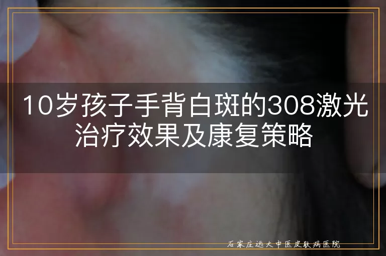 10岁孩子手背白斑的308激光治疗效果及康复策略