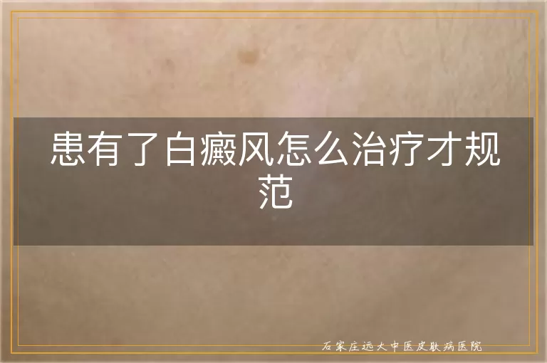 患有了白癜风怎么治疗才规范