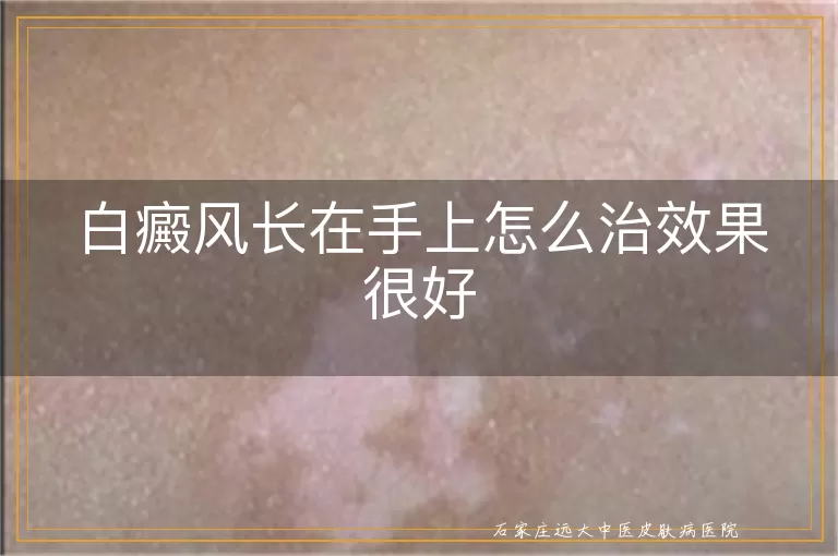 白癜风长在手上怎么治效果很好