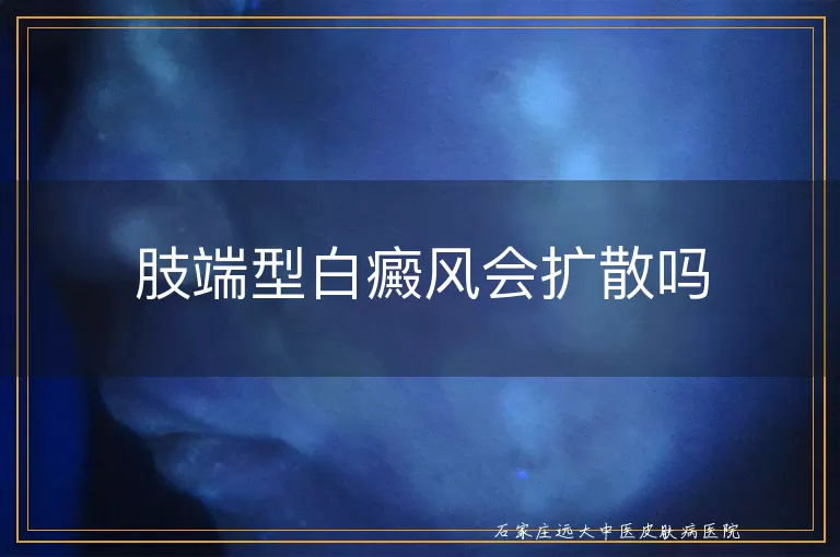 肢端型白癜风会扩散吗