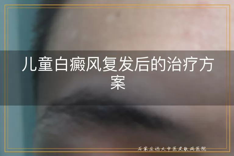 儿童白癜风复发后的治疗方案