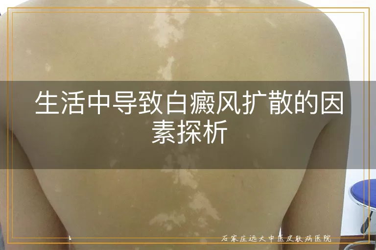 生活中导致白癜风扩散的因素探析
