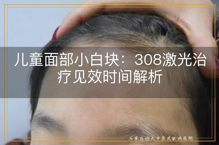 儿童面部小白块：308激光治疗见效时间解析