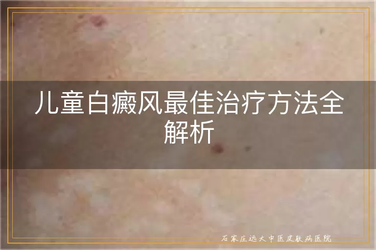 儿童白癜风最佳治疗方法全解析