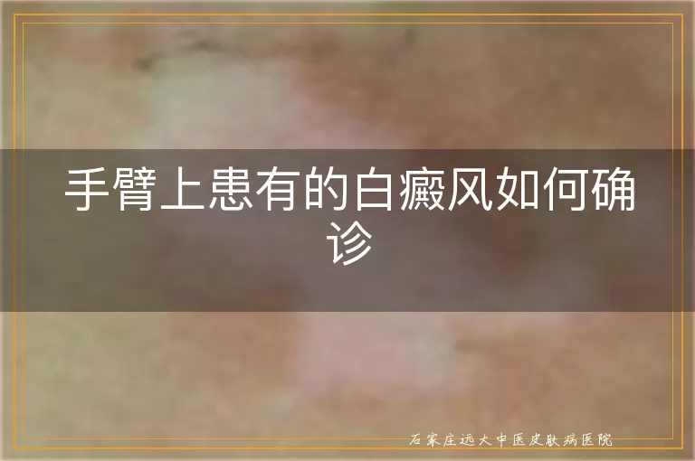 手臂上患有的白癜风如何确诊