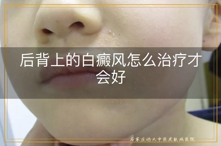 后背上的白癜风怎么治疗才会好