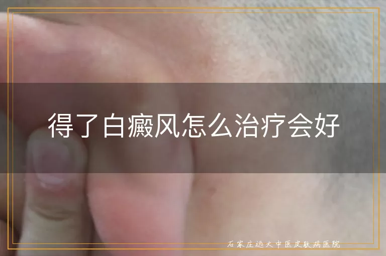 得了白癜风怎么治疗会好