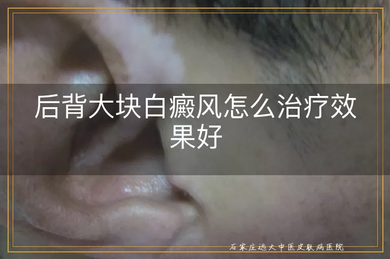 后背大块白癜风怎么治疗效果好