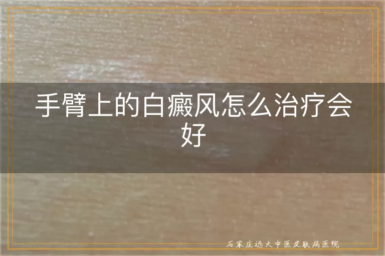 手臂上的白癜风怎么治疗会好