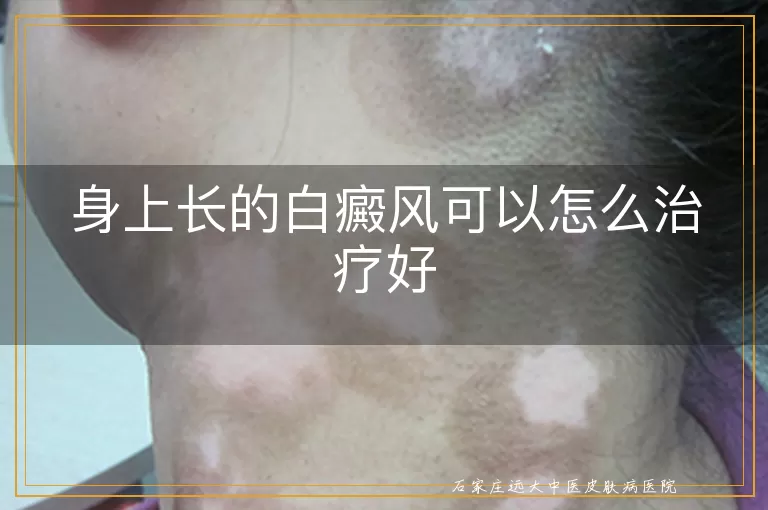 身上长的白癜风可以怎么治疗好