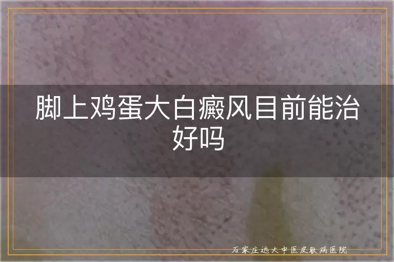 脚上鸡蛋大白癜风目前能治好吗