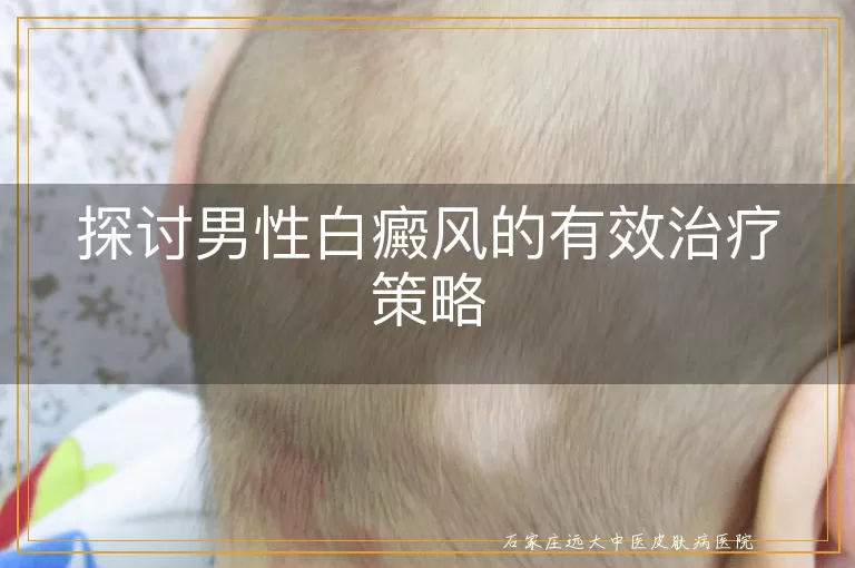 探讨男性白癜风的有效治疗策略