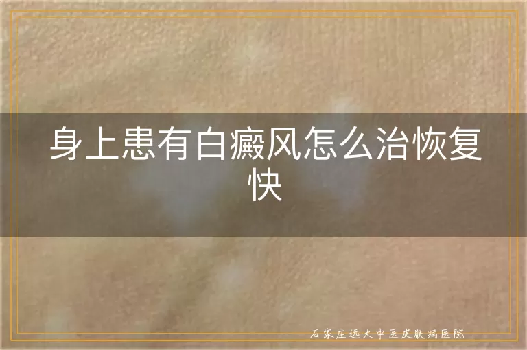 身上患有白癜风怎么治恢复快