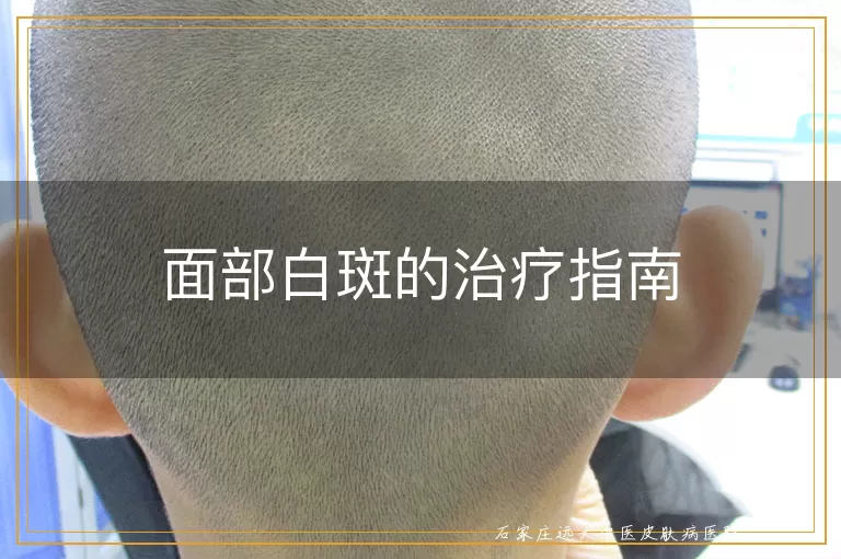 面部白斑的治疗指南