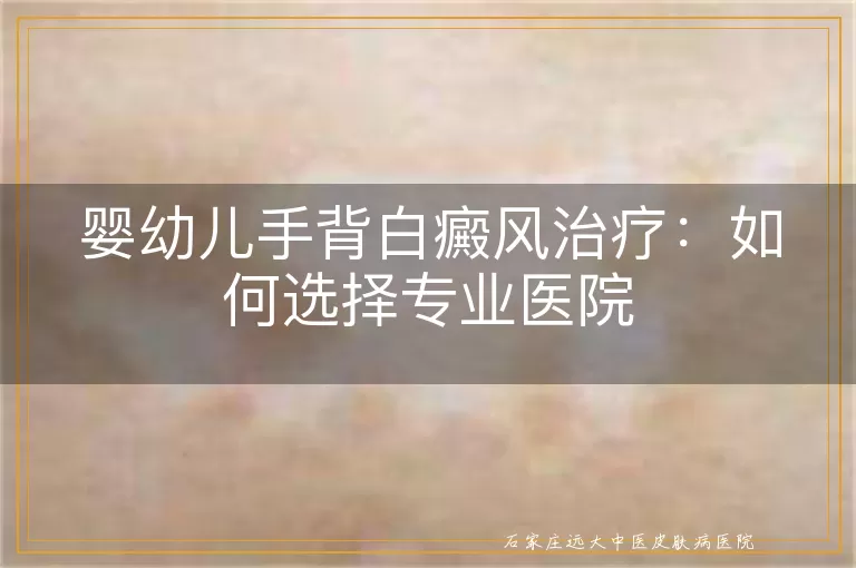 婴幼儿手背白癜风治疗：如何选择专业医院