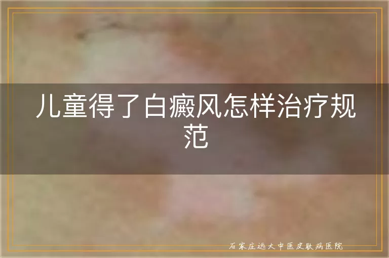 儿童得了白癜风怎样治疗规范