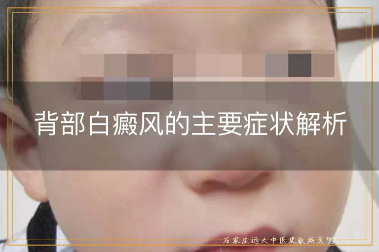 背部白癜风的主要症状解析