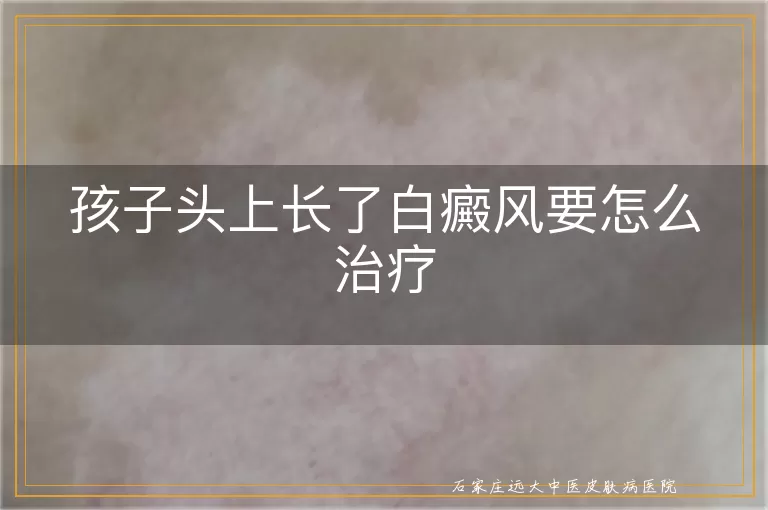 孩子头上长了白癜风要怎么治疗