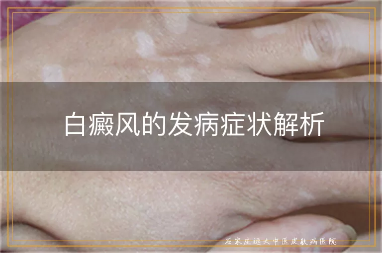 白癜风的发病症状解析