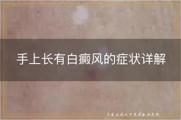 手上长有白癜风的症状详解