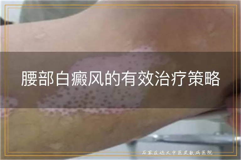腰部白癜风的有效治疗策略