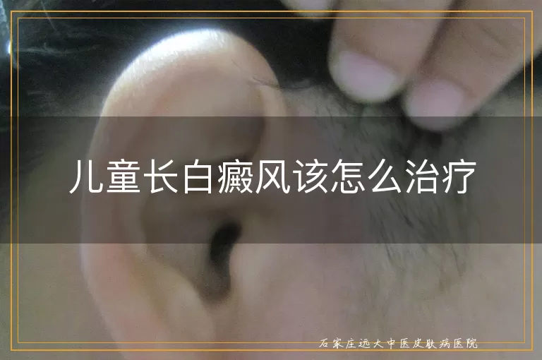 儿童长白癜风该怎么治疗