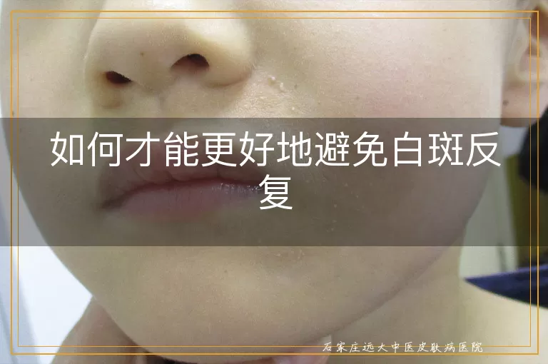 如何才能更好地避免白斑反复