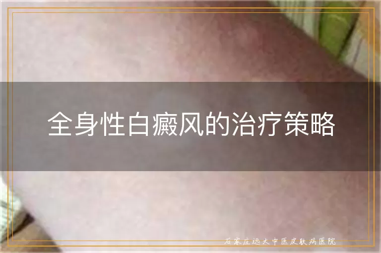 全身性白癜风的治疗策略