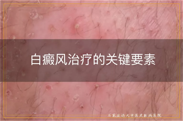 白癜风治疗的关键要素