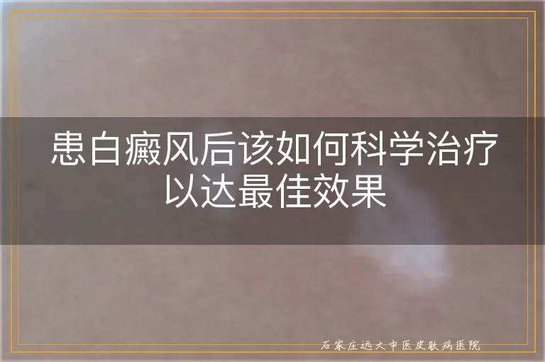 患白癜风后该如何科学治疗以达最佳效果