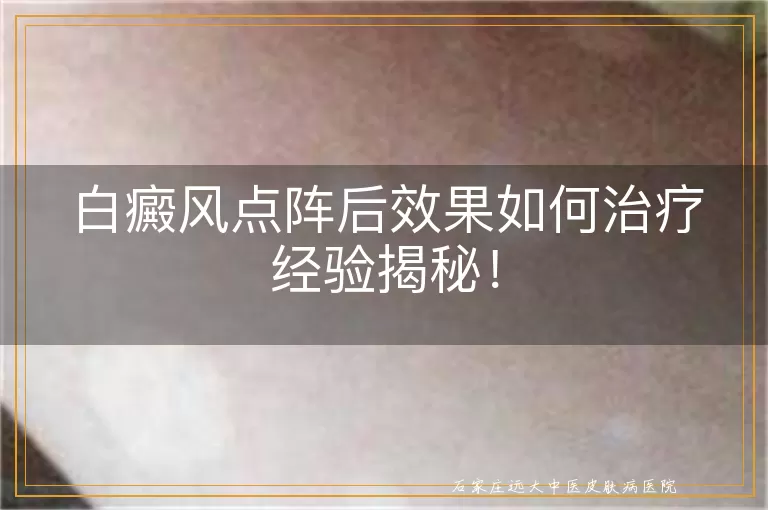 白癜风点阵后效果如何治疗经验揭秘！